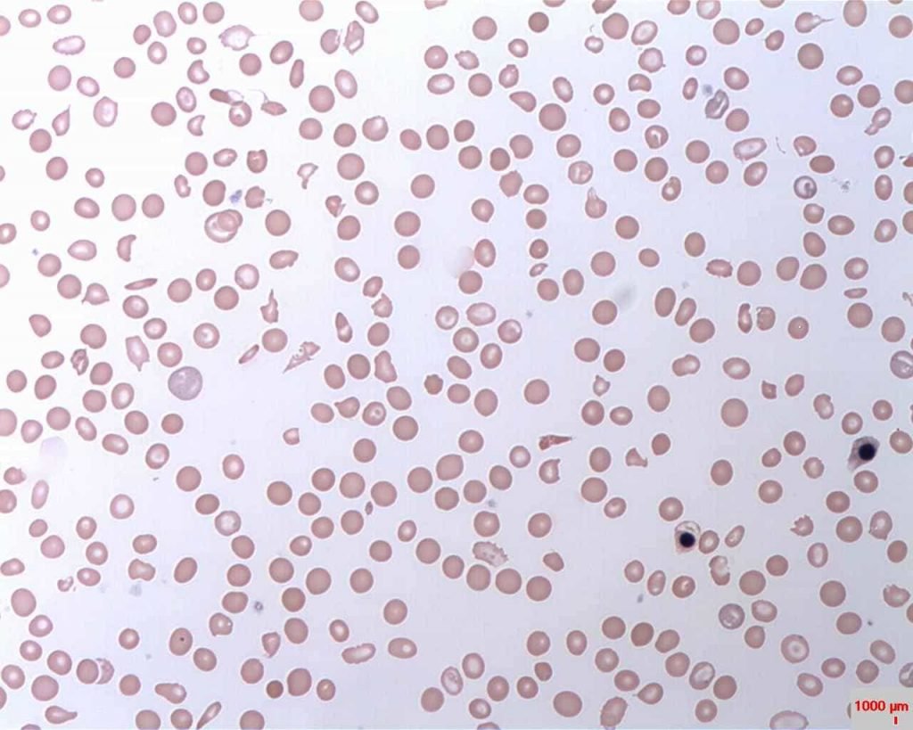 Hemolytic anemia - haemolytic anemia - autoimmune hemolytic anemia - types of hemolytic anemia - red cell indices in hemolytic anemia