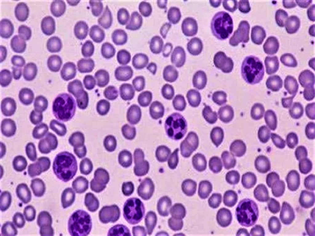 megaloblastic anemia