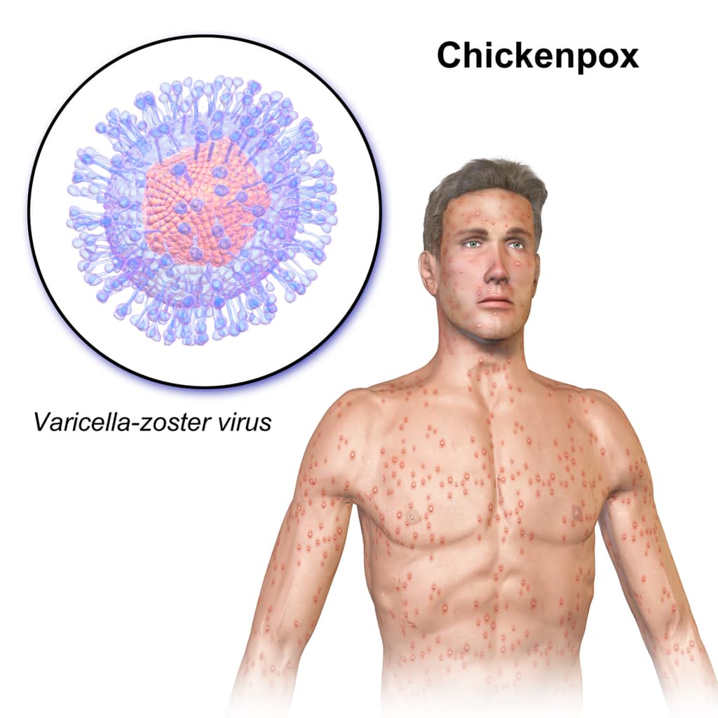 VARICELLA-ZOSTER VIRUS - CHICKENPOX - SHINGLES - HERPES ZOSTER