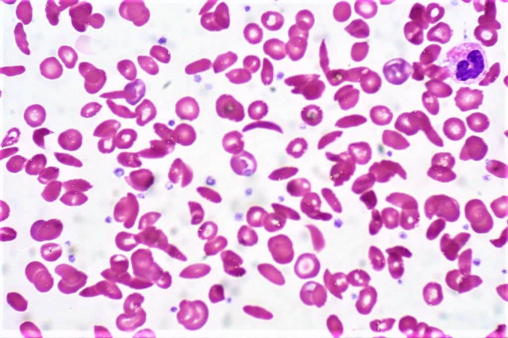 sickle cell anemia - sickle shape rbc - red cell indices in sickle cell anemia