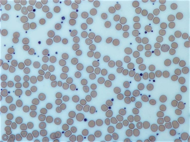 Total Platelet Count Using Hemocytometer Hematology Practicals