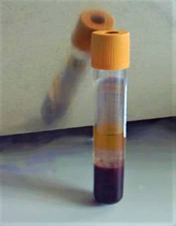 serum in serum separator tube - sst - serum specimen