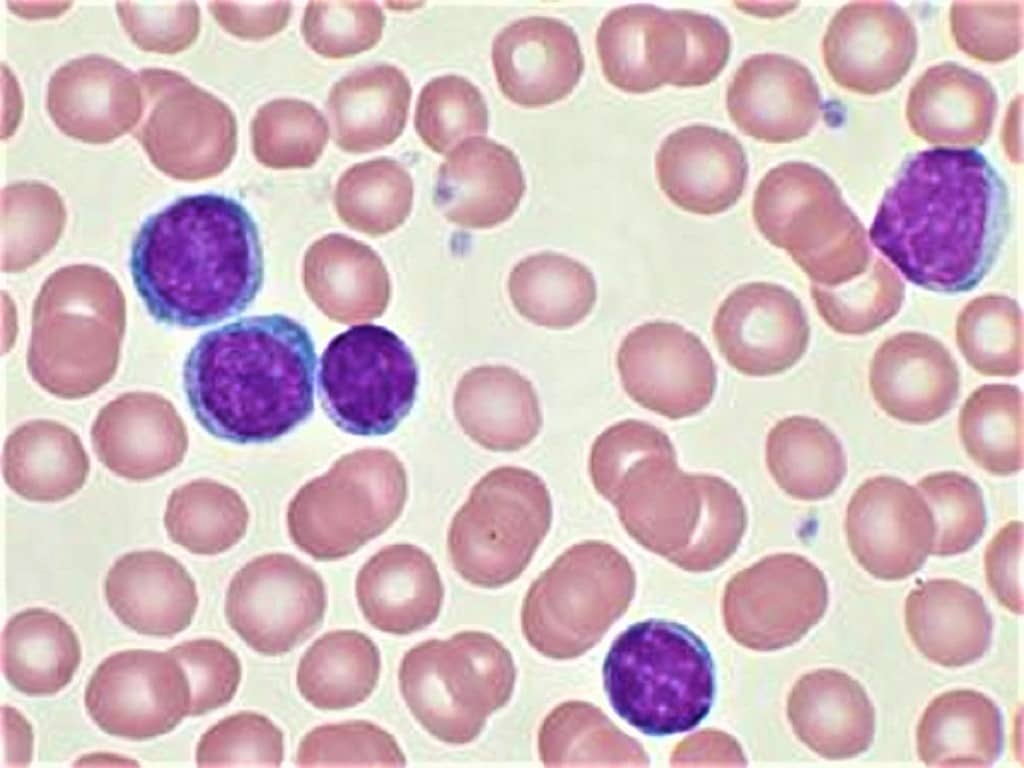 What Are The Chances Of Surviving Acute Lymphoblastic Leukemia