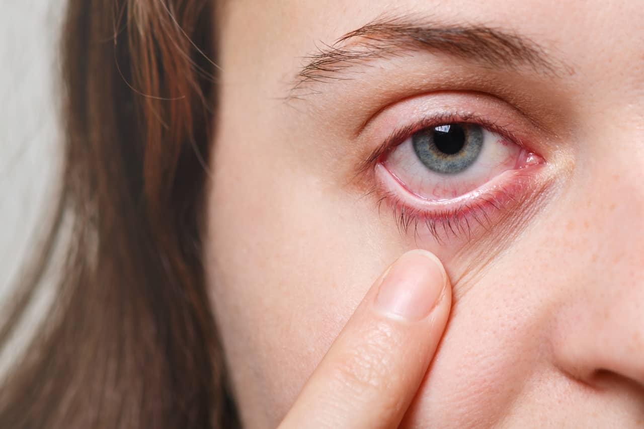 How To Treat Swollen Eyes From Allergies Toddler