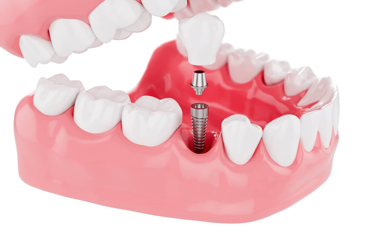 Implants Cosmetic Dentistry